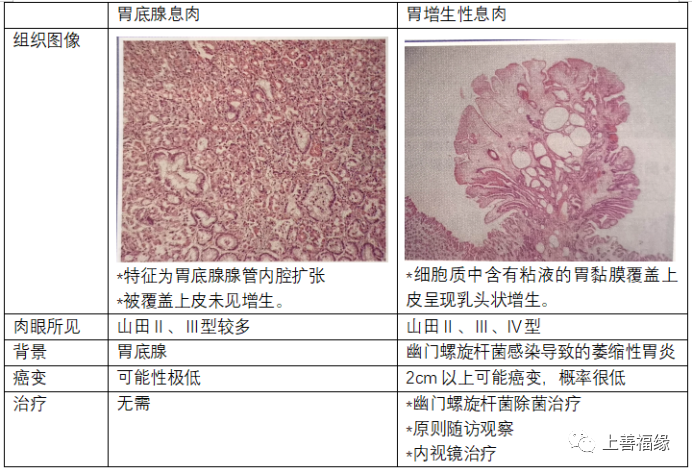 *胃底腺息肉与胃粘膜同色,产生于胃底腺区域(有褶皱的区域),胃增生性