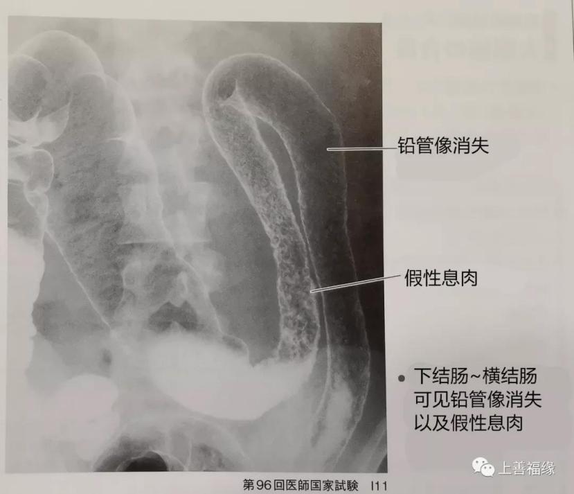 溃疡性结肠炎