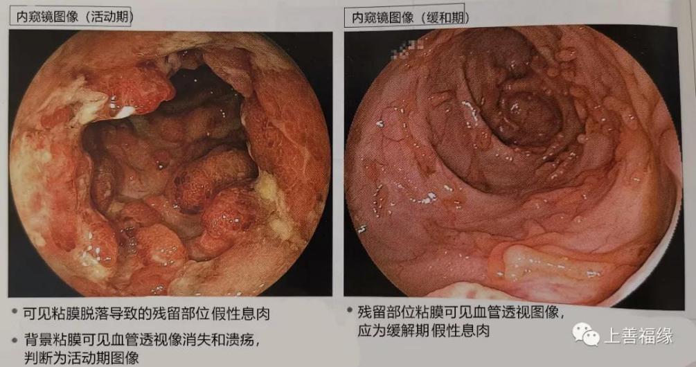 溃疡性肠结核图片