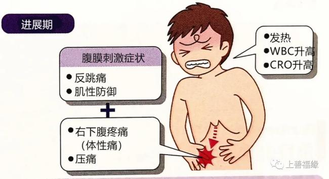 阑尾的炎症会扩展到壁腹膜,从而产生局限于右下腹部的体性痛或压痛
