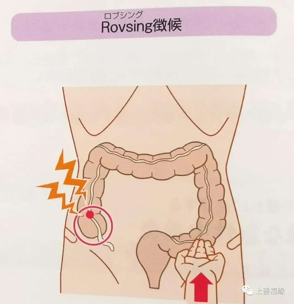 rovsing征图片