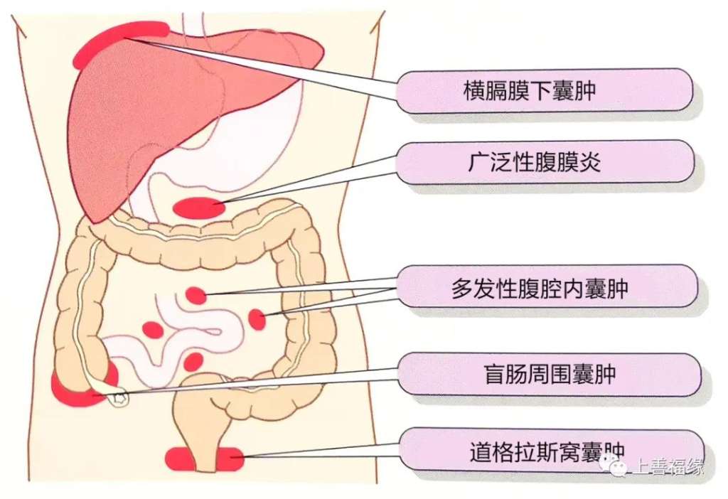 阑尾在哪个部位女性图片