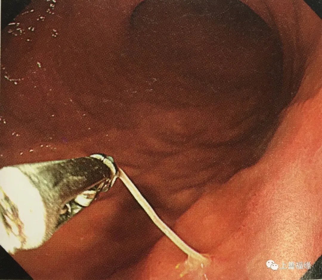 急性胃黏膜病变agml