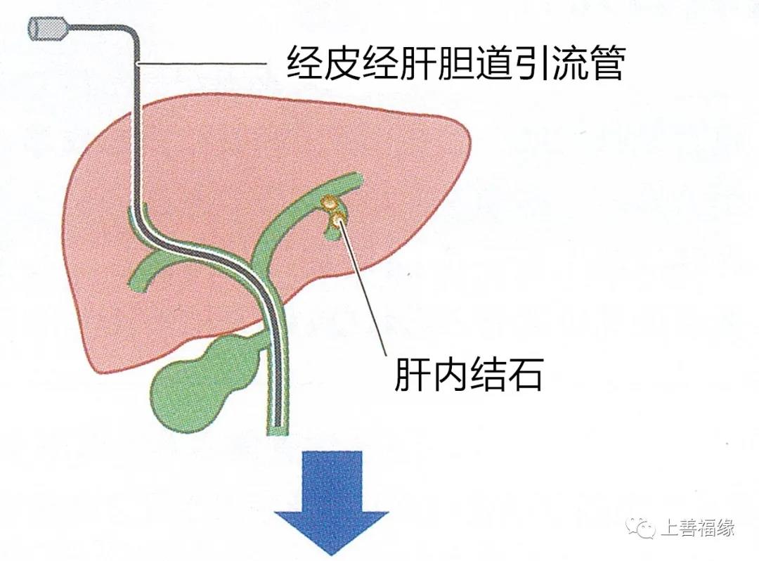 膽結石3