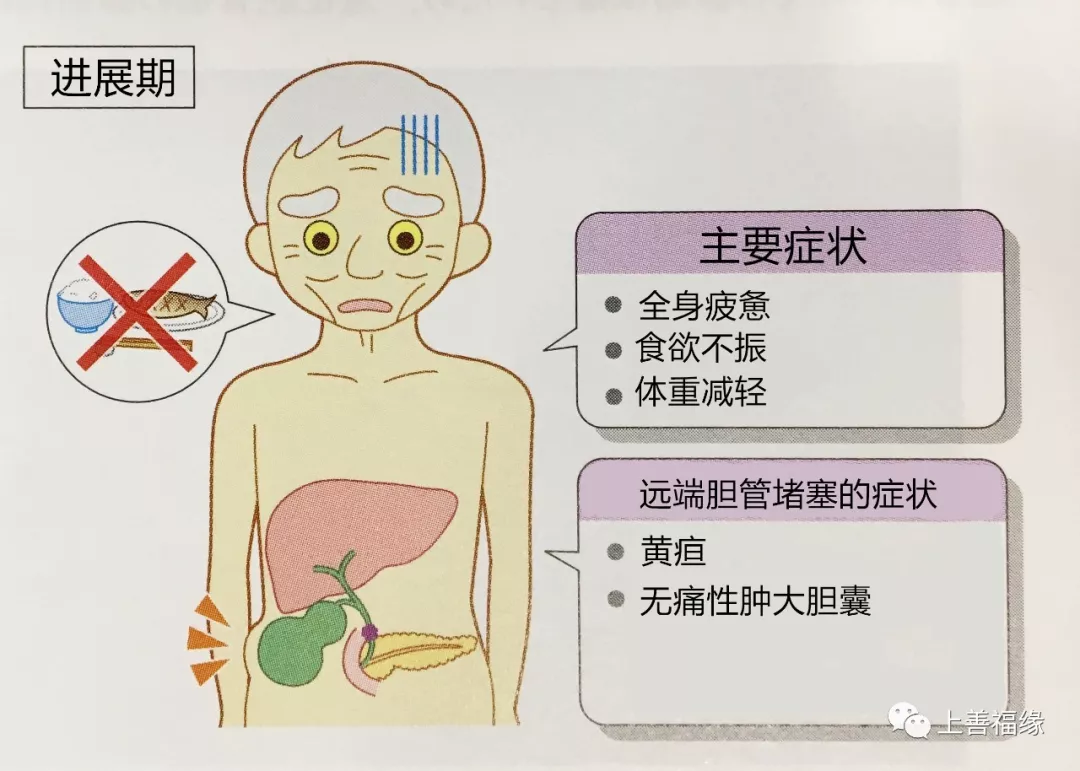 胰头癌压迫胆总管出现阻塞时