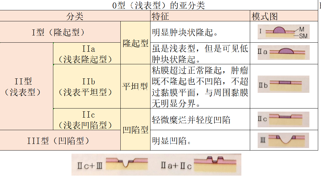 进展期胃癌分型图片