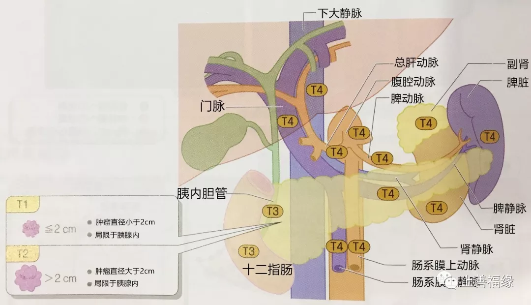 局部分期t因子★胰腺癌分期是根据肿瘤大小及局部分期